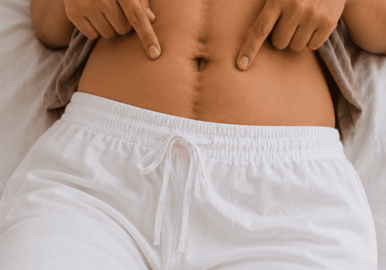 Diastasis Recti: Why Your Belly Still Looks Pregnant (And What You Can Do About It)